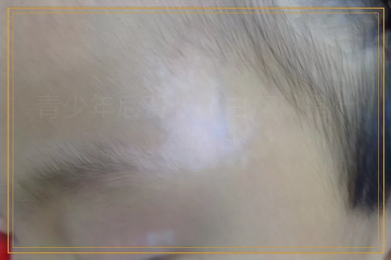 青少年后背长了白癜风是什么原因