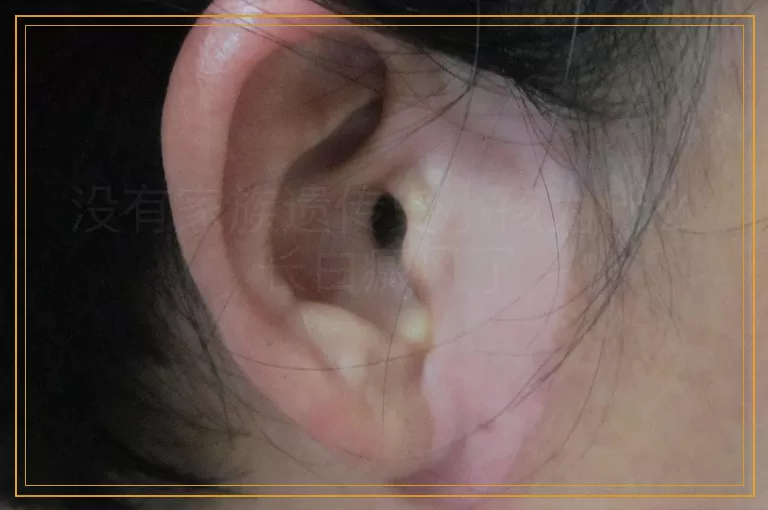 没有家族遗传史小孩为什么长白癜风了