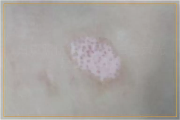 白斑照伍德灯显瓷白色荧光是白癜风吗