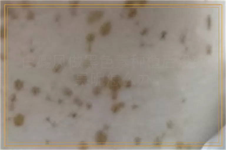 白癜风做黑色素种植后没效果呢怎么办