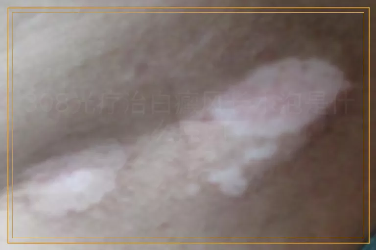 308光疗治白癜风长水泡是什么原因