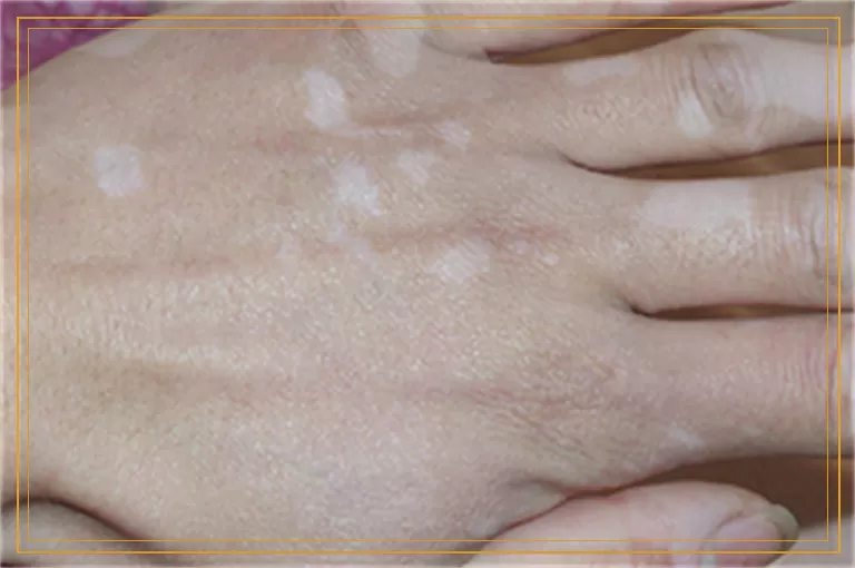 四个月宝宝身上有白斑该怎么治