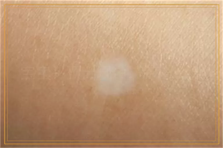 宝宝头顶出现白斑该怎么办