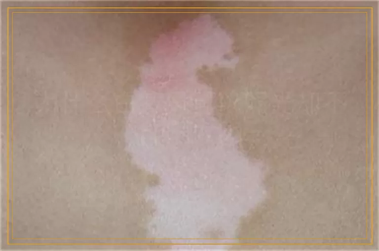 为什么白癜风可以照光却不能晒太阳