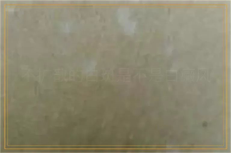 不扩散的白斑是不是白癜风