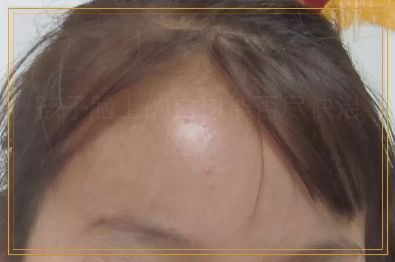 孩子脸上的白斑能否尽快治好