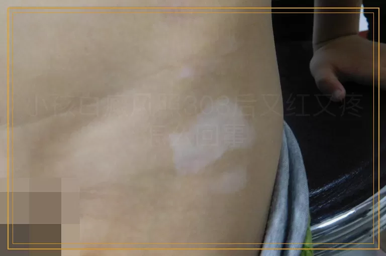 小孩白癜风照308后又红又疼怎么回事