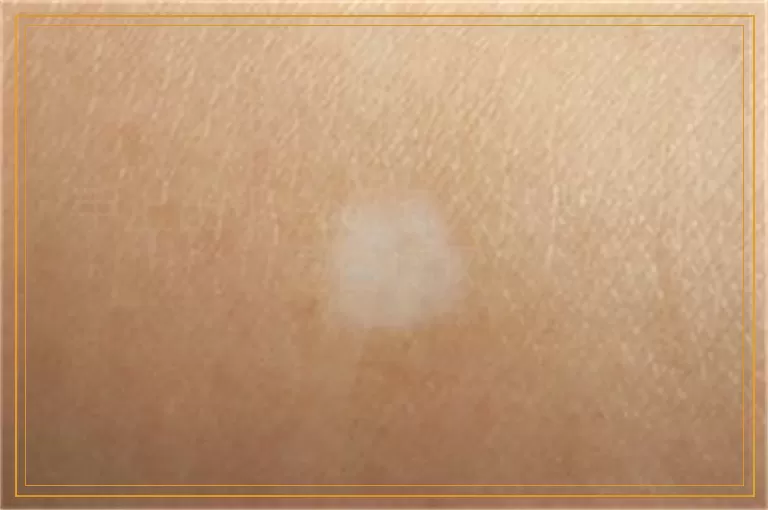 手上出现白斑怎么检查是不是白癜风