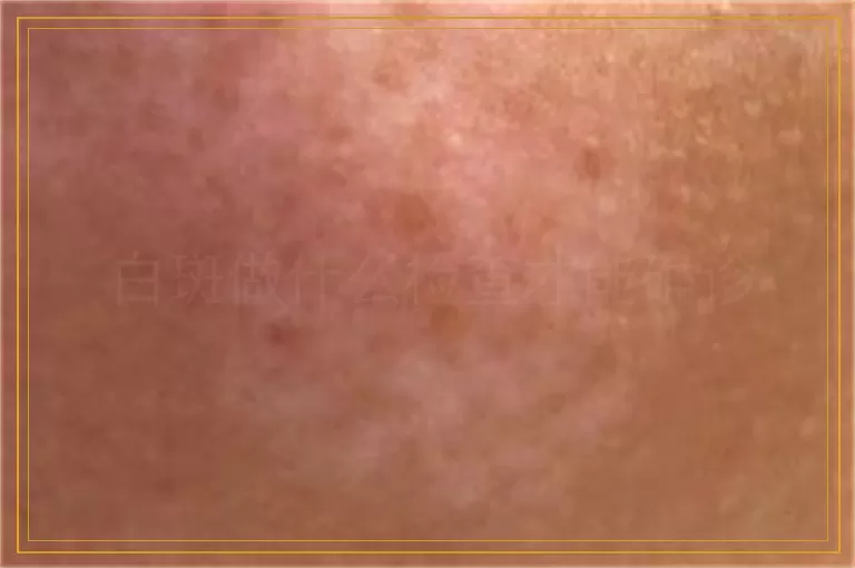 白斑做什么检查才能确诊