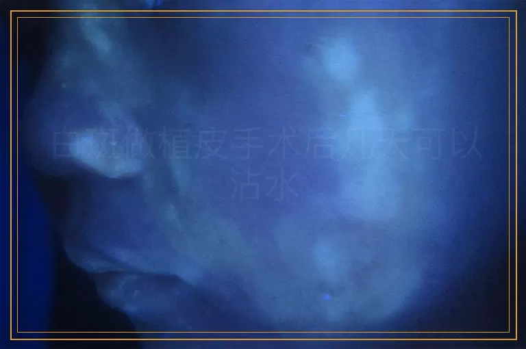 白斑做植皮手术后几天可以沾水