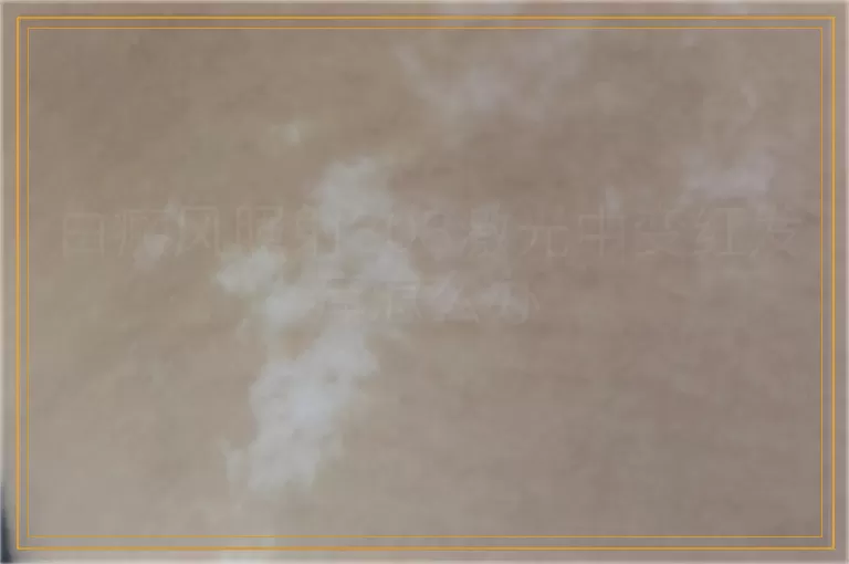 白癜风照射308激光中变红发痒怎么办