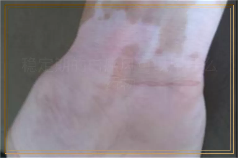 稳定期的白癜风可以用什么药物