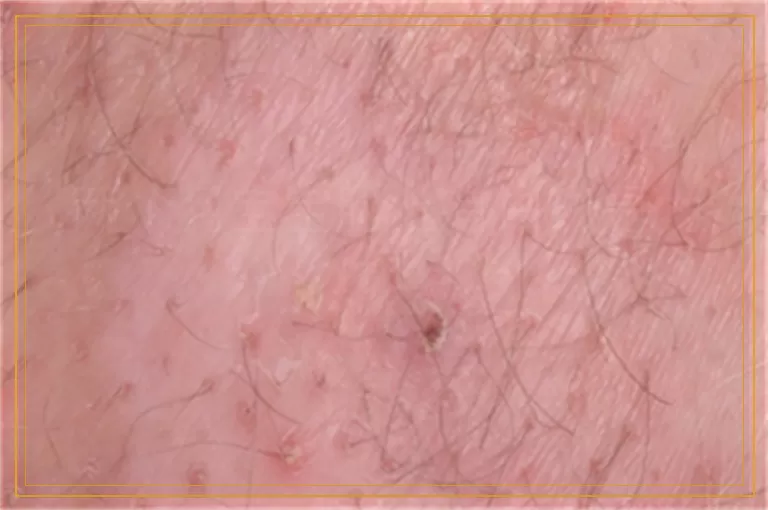 两个月宝宝脸上有白斑是为什么