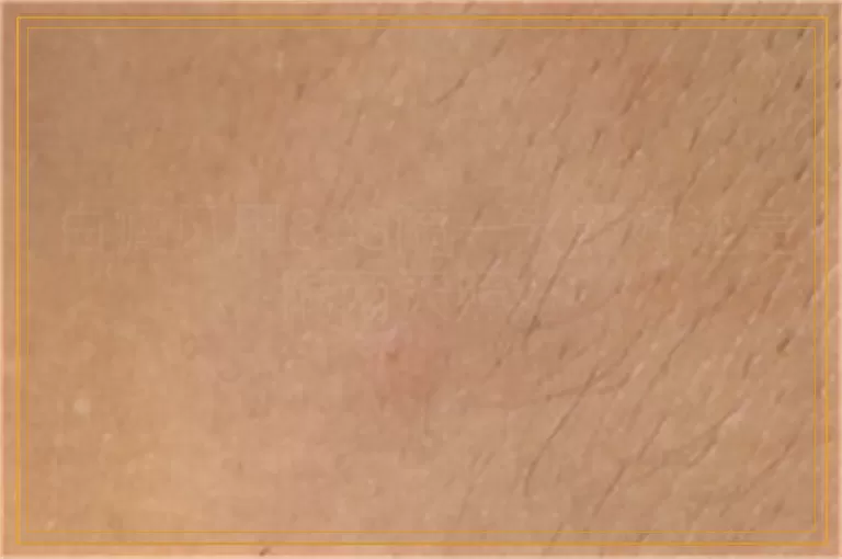 白癜风用308隔一天照好还是隔两天照好