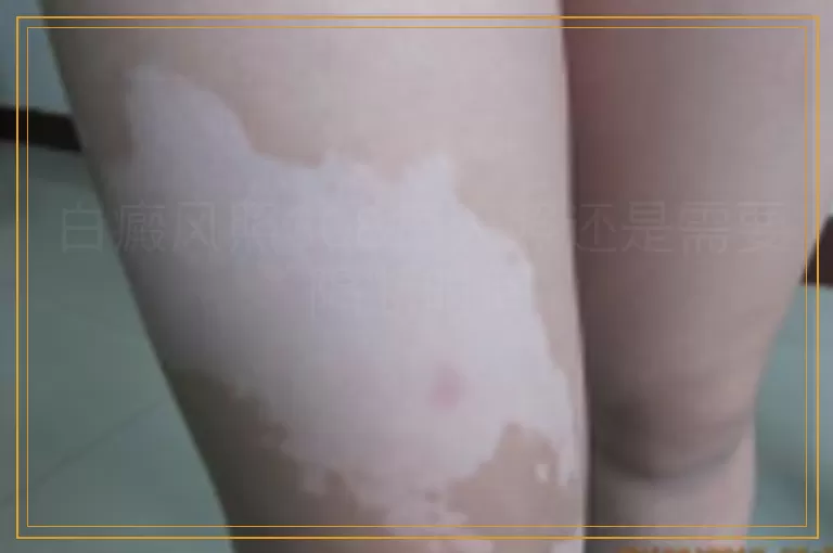 白癜风照308每天照还是需要隔断时间