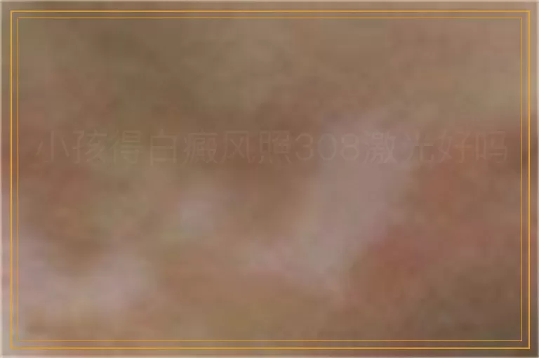 小孩得白癜风照308激光好吗