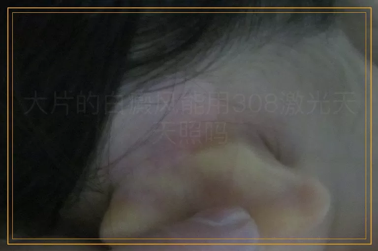 大片的白癜风能用308激光天天照吗