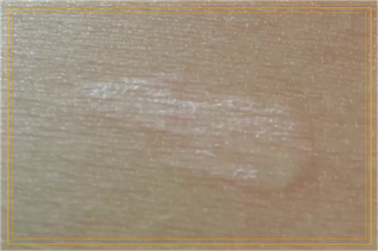 为什么白癜风总是复发在脸上