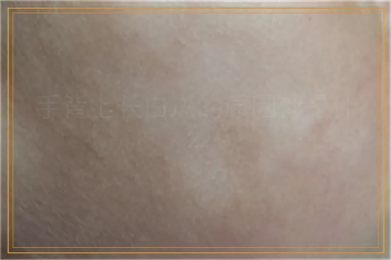 手背上长白斑的原因都是什么