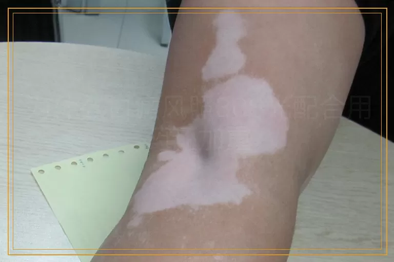 为什么白癜风照308光配合用药还加重