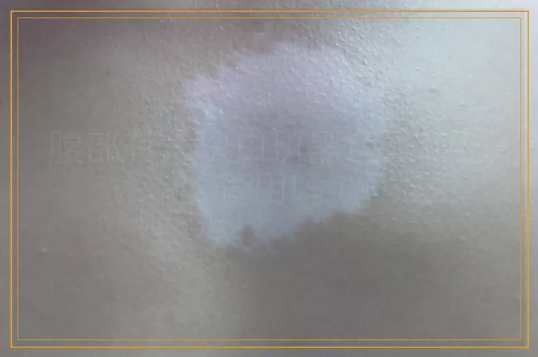 腹部有大块白斑黑色素种植管用吗