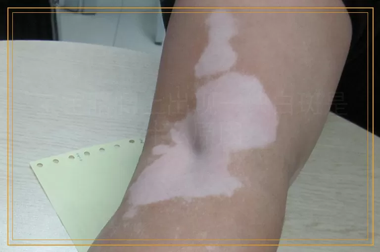 宝宝胳膊上出现一块白斑是什么原因