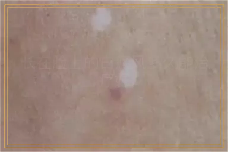 长在脸上的白癜风多久能治疗好
