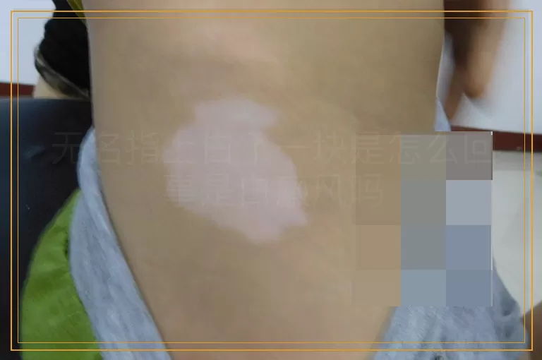 无名指上白了一块是怎么回事是白癜风吗