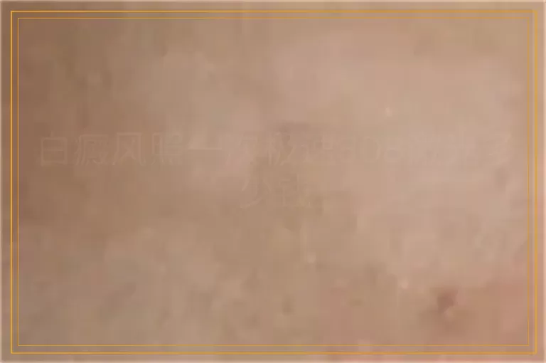 白癜风照一次极速308激光多少钱