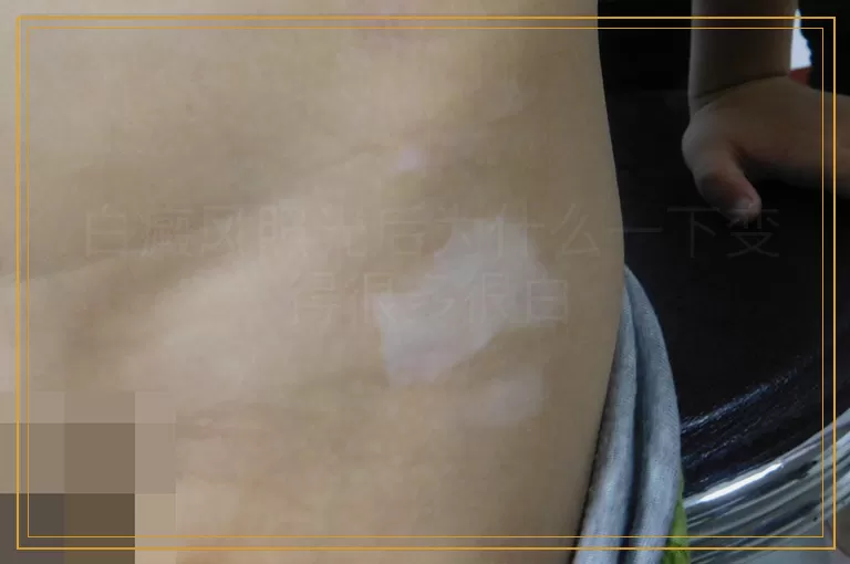 白癜风照光后为什么一下变得很多很白