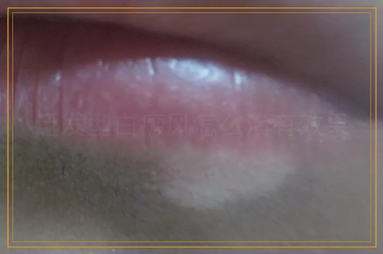 泛发型白癜风怎么治有效果