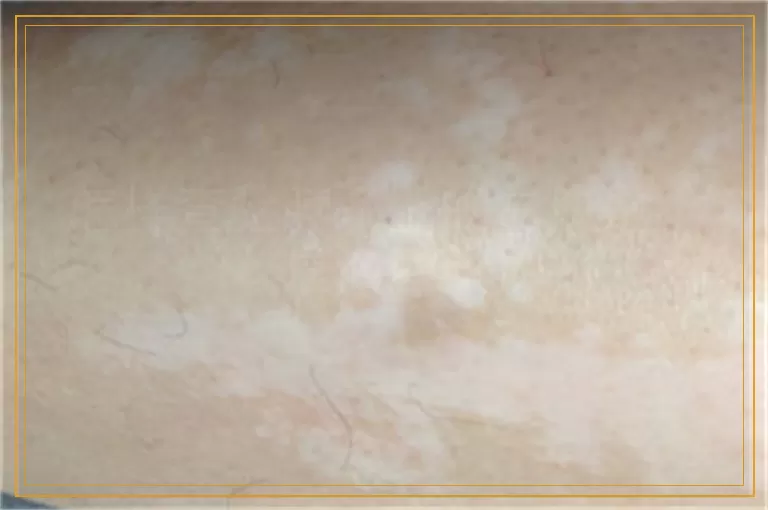 怎样查验脖子上的白块是不是白癜风