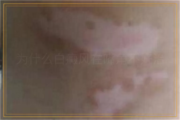 为什么白癜风在嘴角不好治