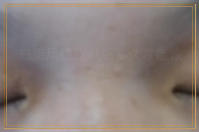 白癜风植皮以后多久才能恢复