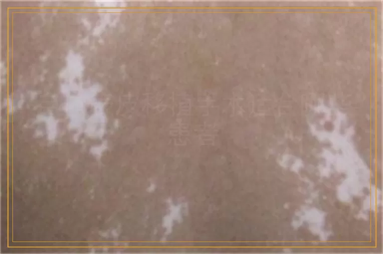 自体表皮移植手术适合哪些患者