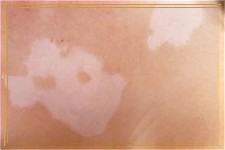 身上出现白块是什么原因怎么治