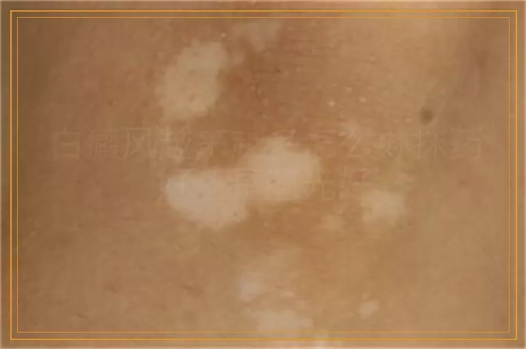 白癜风越来越多怎么办抹药好还是照光好