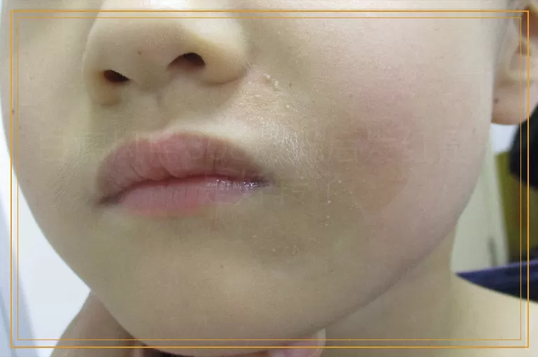 白癜风照308激光后发红是不是好转了