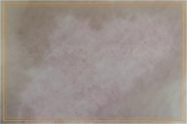 308激光照白癜风照几次能看到好转
