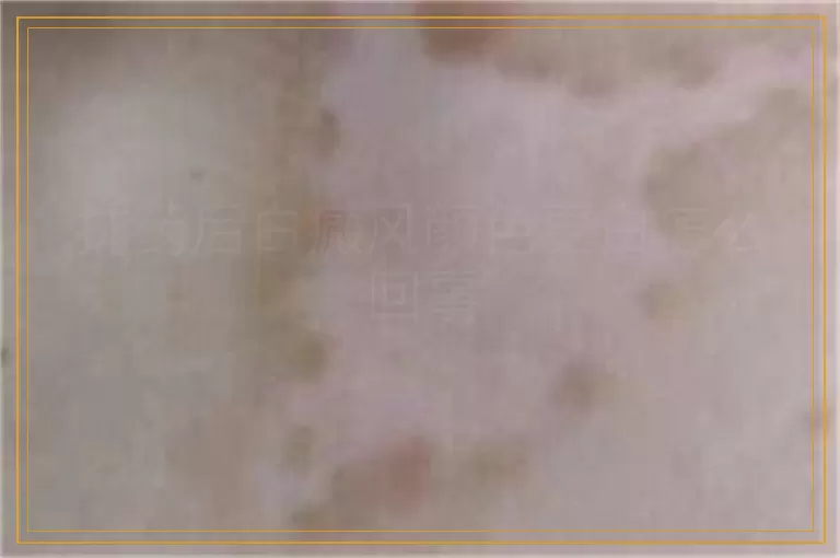 抹药后白癜风颜色更白怎么回事