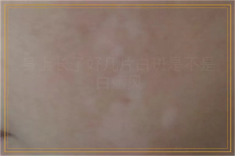 身上长了好几片白斑是不是白癜风