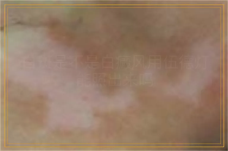 白斑是不是白癜风用伍德灯能照出来吗
