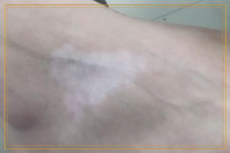 白癜风的诊断和鉴别诊断是什么样