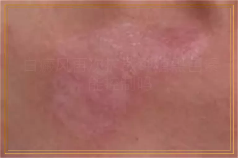 白癜风再次扩散种植黑色素能控制吗