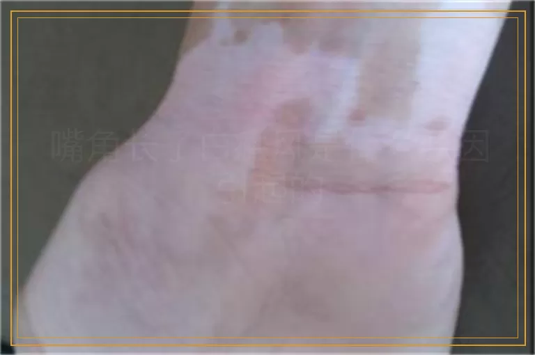 嘴角长了白癜风是什么原因引起的