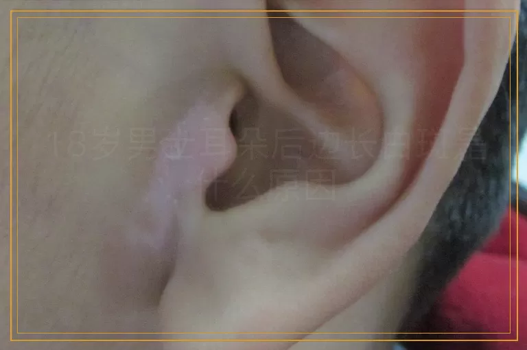 18岁男士耳朵后边长白斑是什么原因