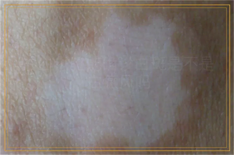 抽血化验能确诊白斑是不是白癜风吗