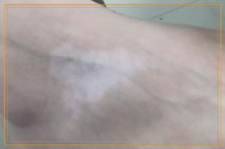 伍德灯下白斑是蓝白色 境界模糊是什意思