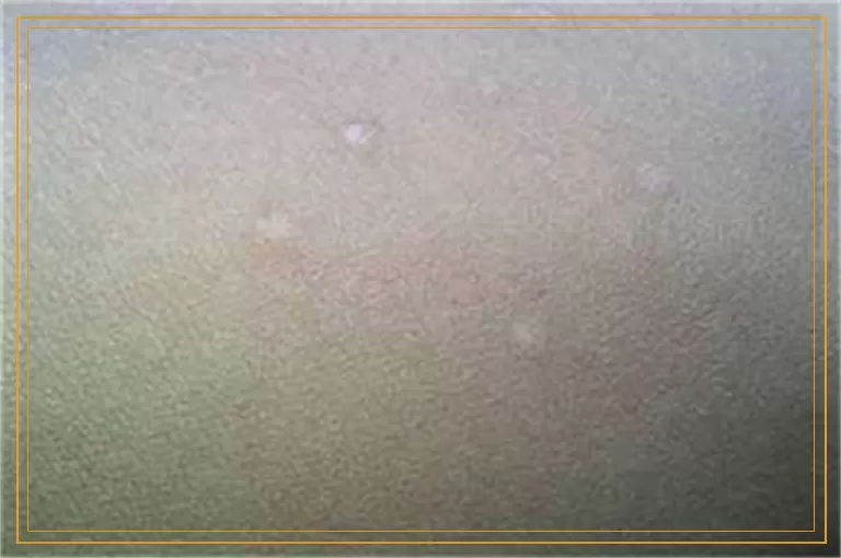 色素减退斑是不是白癜风两者有什么区别