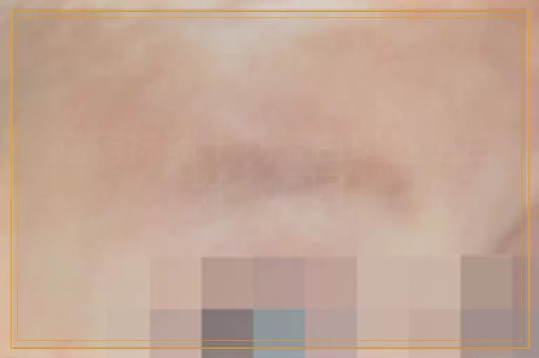 吃药抹药十几天白斑处更白什么原因